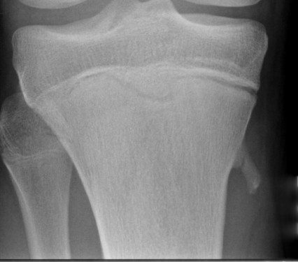 Tibial Osteochondroma with Fracture